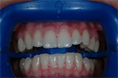 Molinare Dental Group | Crowns  amp  Caps, Teeth Whitening and Veneers